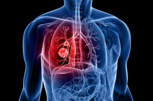 Cancer Services - Cancer Types - Lung Cancer - Meet the Team - Introduction Cancer Services - Cancer Types - Lung Cancer - Meet the Team - Introduction